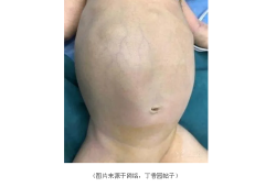 胎儿巨肠结（胎儿巨肠结 能确诊嘛）
