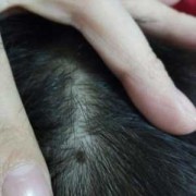 胎儿长痣（小孩为什么会长痣）