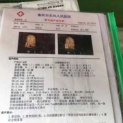 胎儿房间隔膨出瘤（胎儿房间隔膨出瘤出生后有什么影响）