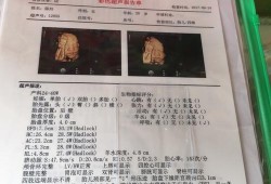 胎儿房间隔膨出瘤（胎儿房间隔膨出瘤出生后有什么影响）