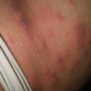孕期大腿内侧红了一块，又痛是怎么回事,孕期大腿根部红肿疼痛