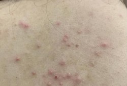 怎么去掉胸前和背后的痘痘和痘印,孕期胸口长痘痘怎么办