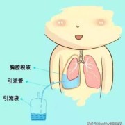 胎儿心包积液怎么办（胸腔积液心包积液怎么治疗）