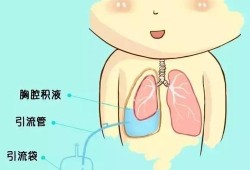 胎儿心包积液怎么办（胸腔积液心包积液怎么治疗）