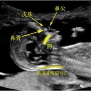 24周胎儿鼻骨正常值（24周胎儿鼻骨长度标准）
