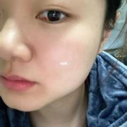 怀孕期间眼睛红怎么办（怀孕期间眼睛红怎么办呢）