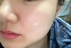 怀孕期间眼睛红怎么办（怀孕期间眼睛红怎么办呢）
