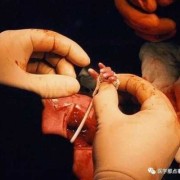 胎儿宫内手术（胎儿宫内手术怎么做）
