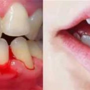 怀孕快9个月了牙出血怎么回事?牙出血是什么原因引起的呢,孕期流牙血怎么回事