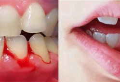 怀孕快9个月了牙出血怎么回事?牙出血是什么原因引起的呢,孕期流牙血怎么回事