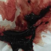 孕期流红色血（孕妇白带带一点点血丝是见红了要生的情况吗）