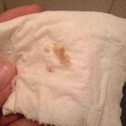 怀孕期间白带发黄图片