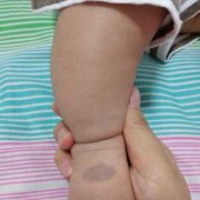 宝宝手背脚背上有胎青,胎儿的胎记是怎么造成的