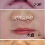 胎儿唇裂手术（胎儿唇裂手术多少钱）