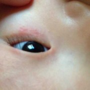 7个月宝宝眼睛周围总起红疙瘩是怎么了,七个多月胎儿图片