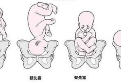 胎儿脸朝下（胎儿脸朝下）