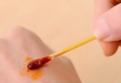孕晚期阴部肿胀疼痛怎么办,孕期下体肿痛可以用碘伏消毒吗