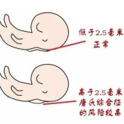 胎儿颈项皮肤增厚（胎儿颈项皮肤增厚什么意思）