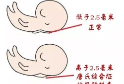 胎儿颈项皮肤增厚（胎儿颈项皮肤增厚什么意思）