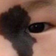 如何避免胎儿长胎记（刚出生的宝宝手背上有黑色胎记怎么消除）