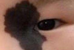 如何避免胎儿长胎记（刚出生的宝宝手背上有黑色胎记怎么消除）