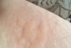 孕晚期大腿内侧长湿疹的很痒怎么治疗,孕期大腿内侧痒痒越抓越痒有小红疙瘩
