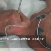 33周早产后遗症多吗,33周胎儿图片真人