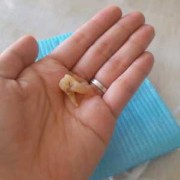 怀孕期间可以拔牙吗（怀孕初期拔掉了一颗大牙怎么办）