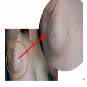 孕妇胸部里面有硬块需要揉散了吗,孕期乳房有硬块怎么办呢