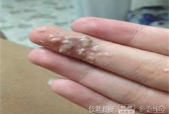 孕期白带豆渣（孕期白色豆渣分泌物多）