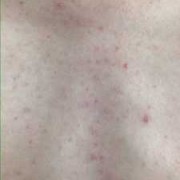 身上长斑是什么原因胸部腰部臀部都长,孕期胸部长斑怎么办呢