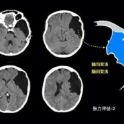 蛛网膜囊肿手术风险大吗?如果不动手术会有什么后果,胎儿蛛网膜囊肿严重吗会影响以后