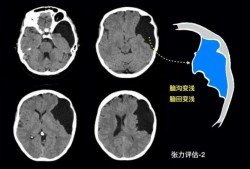 蛛网膜囊肿手术风险大吗?如果不动手术会有什么后果,胎儿蛛网膜囊肿严重吗会影响以后