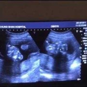 孕早期b超做多了好吗,一个月做了4次b超对胎儿有影响吗