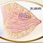 孕期乳房肿块（孕期乳房肿块变大变硬）