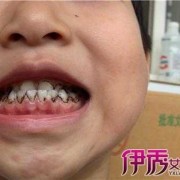 孕期牙齿变黑了怎么办（生完孩子后牙齿有些发黑）