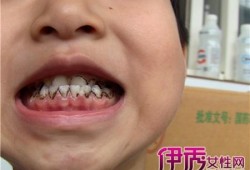 孕期牙齿变黑了怎么办（生完孩子后牙齿有些发黑）