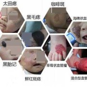胎儿胎记是什么原因造成,胎儿长胎记的原因有哪些呢?