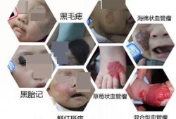 胎儿胎记是什么原因造成,胎儿长胎记的原因有哪些呢?