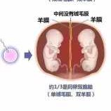 胎儿带羊膜（双胞胎胎儿之间有隔膜）