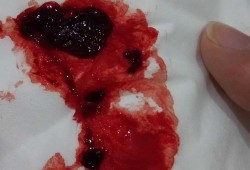 孕期子宫血块多久吸收（孕妇子宫有血块对胎儿有影响吗）