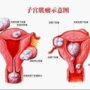 子宫肌瘤会影响胎儿发育吗（怀孕子宫肌瘤会影响胎儿发育吗）