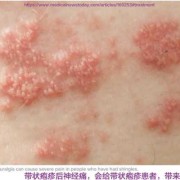 带状疱疹会对孕妇中的胎儿造成影响吗,孕期疱疹病毒感染