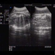 胎儿腹部肠管回声增强必须做羊穿吗,胎儿肠道回声增强怎么回事,其他正常