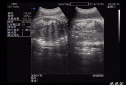胎儿腹部肠管回声增强必须做羊穿吗,胎儿肠道回声增强怎么回事,其他正常