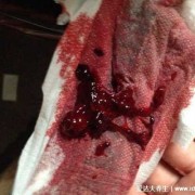 怀孕初期子宫内膜脱落是咋回事啊,孕期子宫内膜脱落出血正常吗