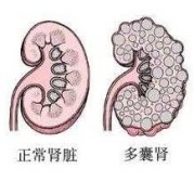 胎儿多囊肾是什么原因造成的（胎儿多囊肾会不会慢慢变好）