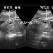 37周胎儿左肾肾盂分离啥意思啊？胎儿的左肾怎么会分离了呢,胎儿肾盂分离是什么意思,严重吗