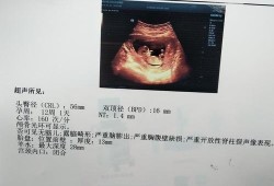 刚出生的婴儿怎么辨别男孩女孩,孕期男孩女孩的区别nt单怎么看