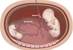 减胎对另一个胎儿有什么影响（减胎对另一个胎儿有什么影响）